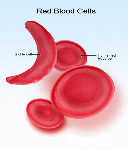 Sickle-cell anemia- A type of genetic disorder