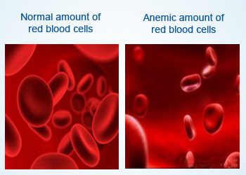 Anemia is a decrease in number of red blood cells