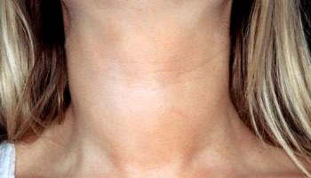 Goiter is caused due to abnormal secretion of thyroid hormones.
