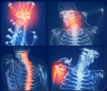 Rheumatoid arthritis 