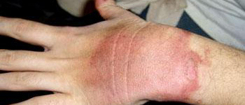 These burns have been caused by steam