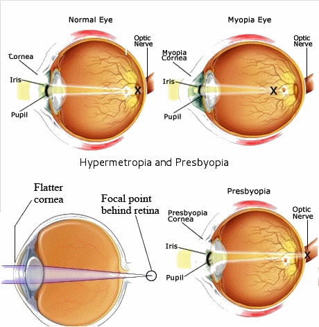 Vision Defects of Human Eye