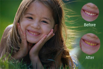 Dental fluorosis