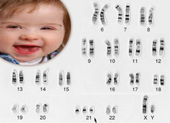 Down syndrome (Trisomy 21)