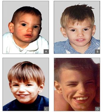 Cri du Chat syndrome