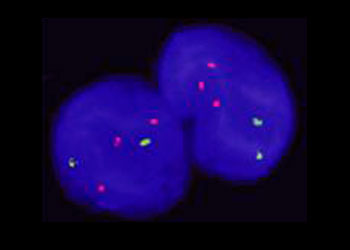 Diagnosing trisomy 21