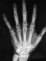 X – ray of human hand showing bone.